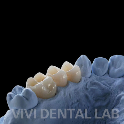 تاج های آزمایشگاهی دندانپزشکی با کنتور کامل و شفافیت بالا