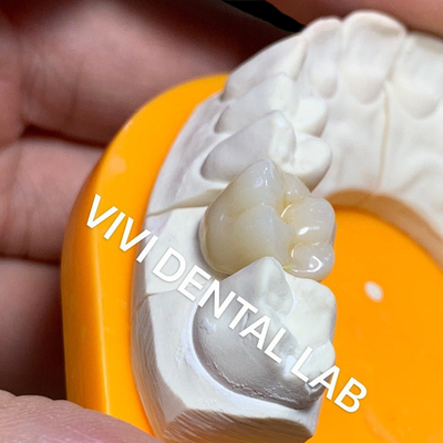 Solid Dental Lab Crowns 3D Pro High Translucency Full Zirconia Crowns China Dental Lab