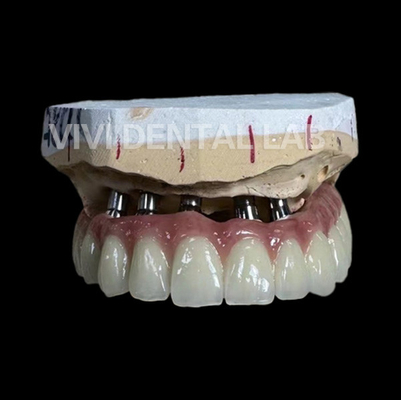 آزمایشگاه دندانپزشکی توتال ایمپلنت PFM Bridge چین