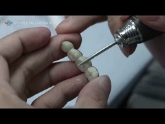 پل فلزی سرامیکی